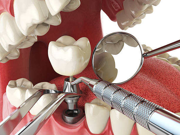 Best Emergency Denture Repair in Kinsey, AL